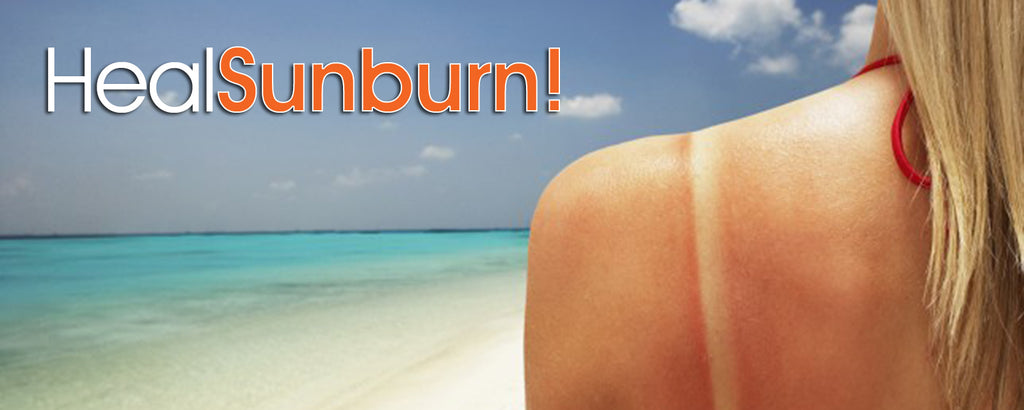 Heal Sunburn!